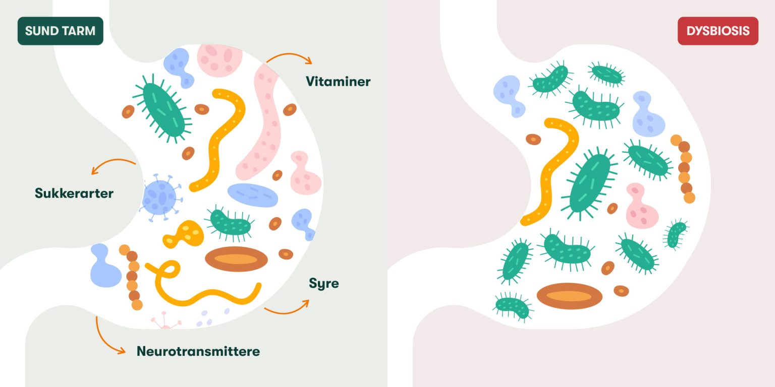 Sammenligning af sund tarm og dysbiose: varieret mikrobiota med vitaminer og neurotransmittere vs bakteriedominans